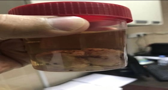 استئصال ورم من فم مولود بمستشفى الولادة والأطفال بأبها 