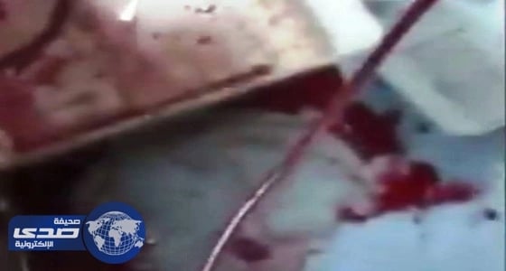 تفاصيل انفجار أنبوب نقل الدم في مواطنة أثناء جلسة غسيل الكلى بالباحة