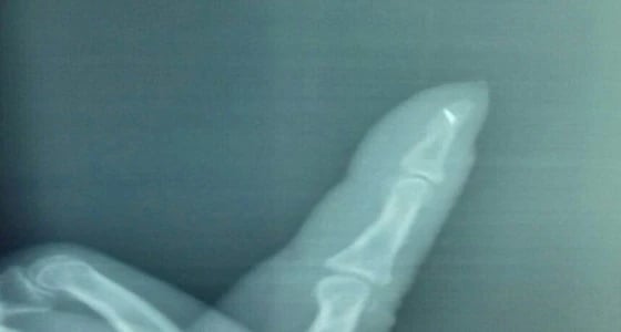 استخراج إبرة خياطة من يد امرأة لازمتها 40 عاما في مهد الذهب