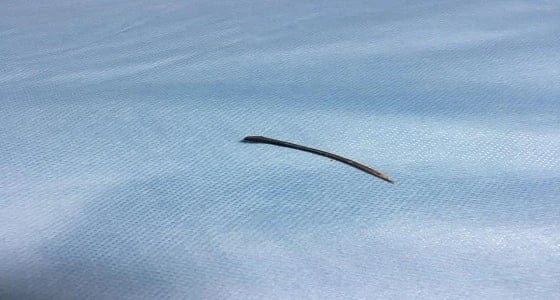 شوكة تخترق أمعاء مريض بعد تناوله وجبة سمك