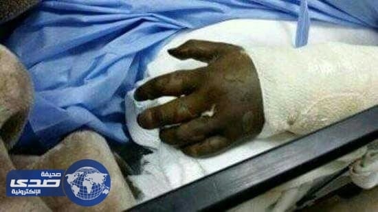 فتاة بترت يدها بسبب خطأ تقرر نقض حكم للصحة يحمل شقيقها 32% من الخطأ