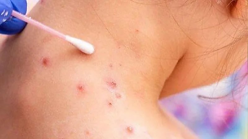 تطوير اختبار جديد يكشف جدري القردة خلال 50 دقيقة