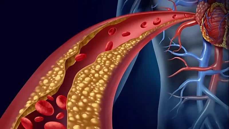 سبب تصلب الشرايين والأمراض الناتجة عنه