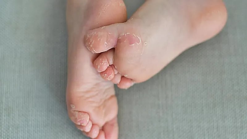 أسباب شائعة تؤدي لتقشر القدمين
