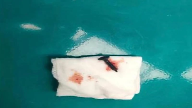 استخراج مسمار من صدر طفل يبلغ من العمر 6 سنوات