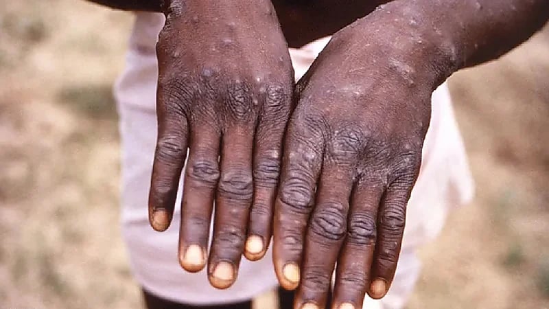 بالفيديو.. استشاري: من فوق 47 عاما قد يحتاجون لجرعات تنشيطة ضد جدري القردة