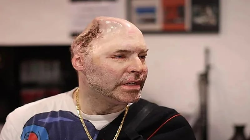 بالصور.. مخدرات تجعل مغني شهير يخسر نصف جمجمته