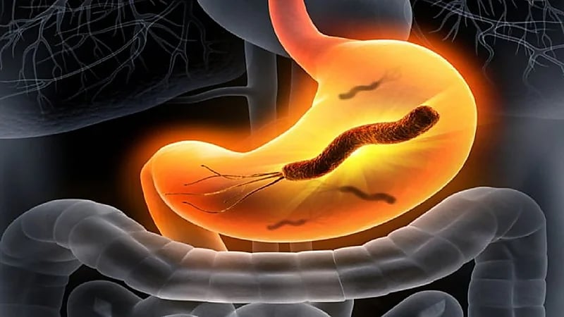 استشاري: نسبة انتشار جرثومة المعدة في بعض المناطق تصل لـ50%