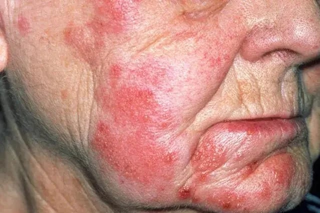 مناطق في الجسم معرضة للإصابة بالحزام الناري .. فيديو