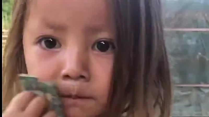 طفلة تايلاندية ينمو شعر على ذراعها كما فروة الرأس ..فيديو