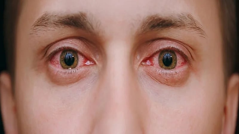 الرمد الربيعي يهاجم العين في فصل الربيع