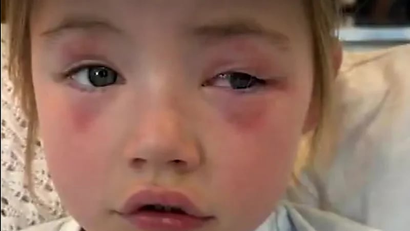 مسحوق غسيل يتسبب في فقد طفلة لبصرها