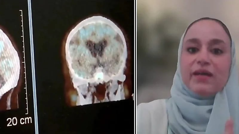 استشارية أعصاب: علاج الزهايمر الجديد يغير أسلوب العلاج ويمنع الوصول للخرف .. فيديو