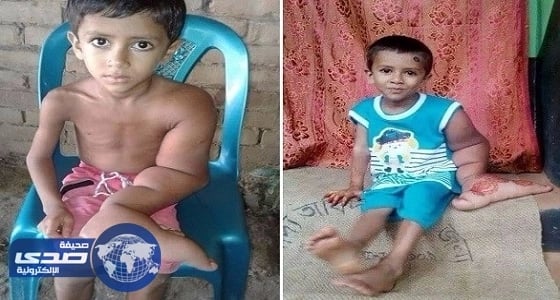 بالصور.. طفل يزيد وزن يده عن 7 كيلو