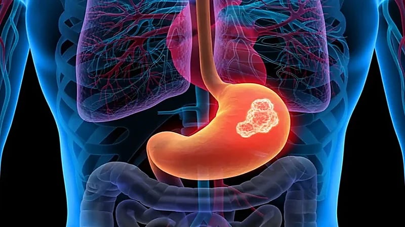 ابتكار علاج ثوري للقضاء على سرطان المعدة