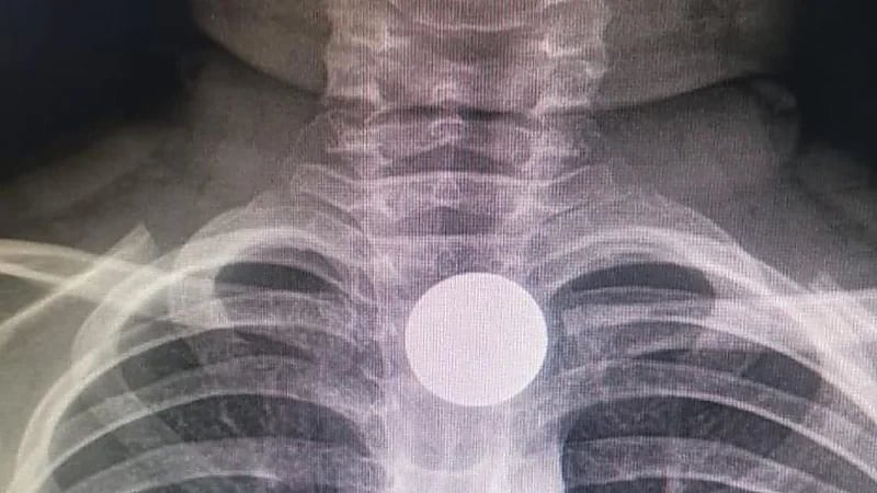 تفاصيل انقاذ حياة طفل في الخفجي ابتلع قطعة معدنية