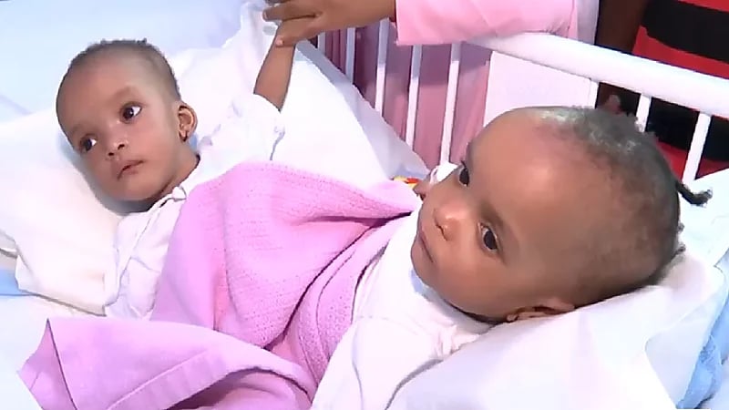 آخر تطورات الحالة الصحية للتوأم السيامي النيجيري حسانة وحسينة