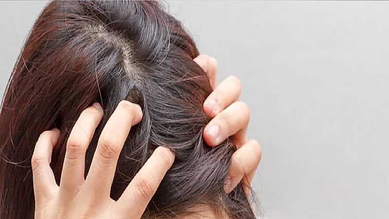 مختصة: الأسيتون مضر لفروة الرأس و"الاكستنشن" قد يسبب الصلع