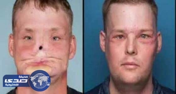 فجر شاب رأسه لكن حدثت معجزة