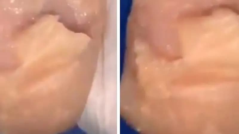 شاهد.. فتاة تلصق قطعة دجاج في كتفها ليتم تطعيمها باللقاح بدلا من جسمها