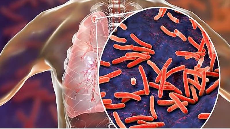 بالفيديو.. 5 علامات تشير لإصابة الفرد بالدرن