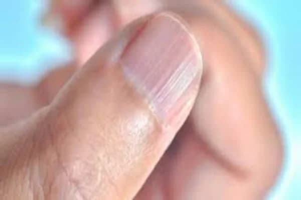 الكشف عن أعراض نقص الزنك الحاد