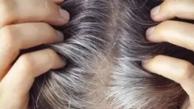 الشيب المبكر: مؤشر صحي لا يجب تجاهله